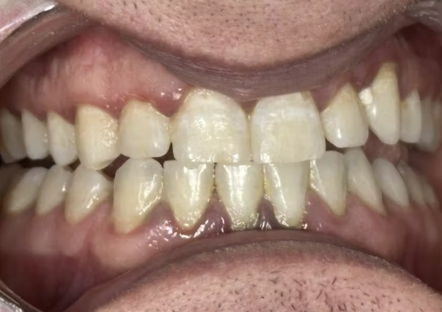 Case lâm sàng về cạo vôi kết hợp đánh bóng bằng bột glycine